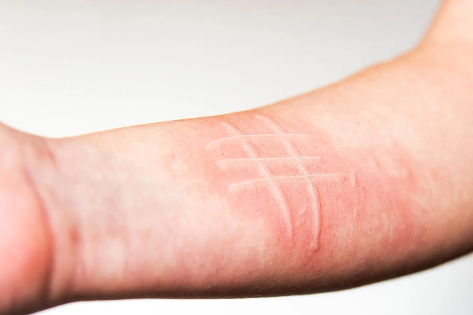 Body Scars